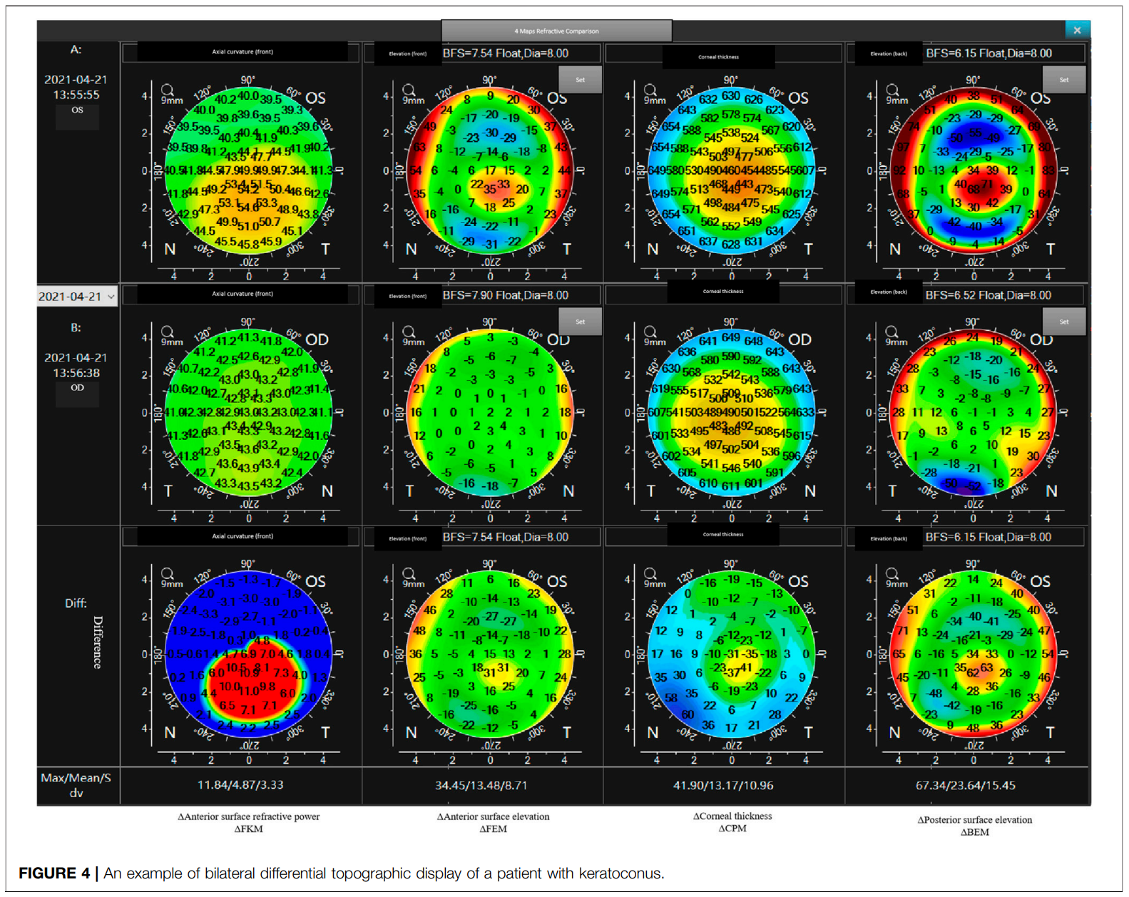 Bilateral Differential Topography—A Novel Topographic Algorithm for Keratoconus and Ectatic Disease Screening