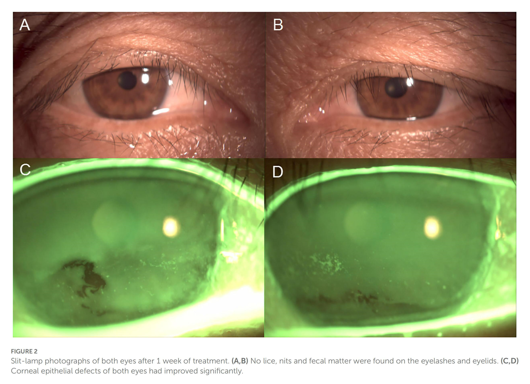 Case report: A case of corneal epithelial injury associated with Pthiriasis palpebrarum